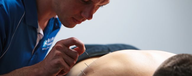 Dry Needling
