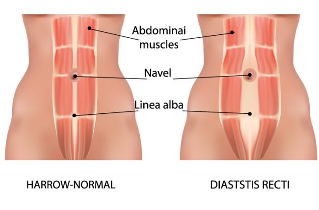 Abdominal-Separation diagram depicting abdominal separation