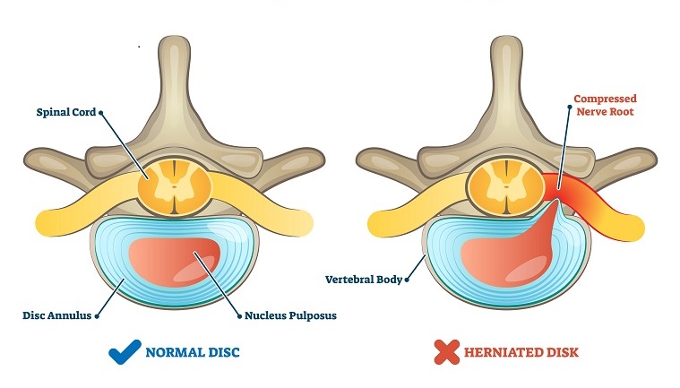 Bulging Disc vs. a Herniated Disc: What's the Difference?: New