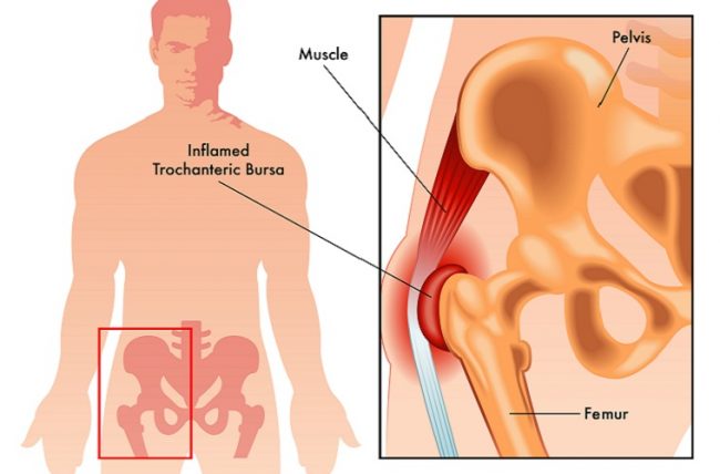 Hip Pain Location Diagram